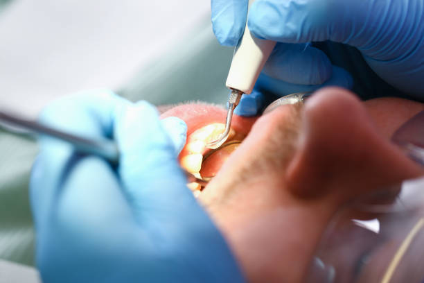 Best Emergency Tooth Extraction in Oakland, MD